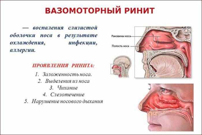 Проявления и симптомы вирусного ринита