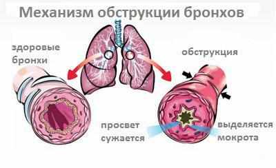 Обструкция бронхов