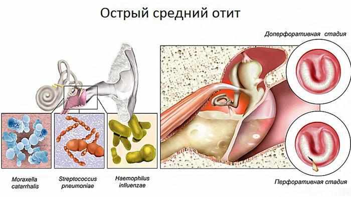 Симптомы острого среднего отита