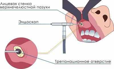 Эндоскопическое удаление кисты гайморовой пазухи