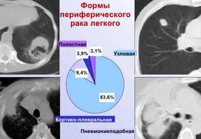 Виды периферического рака легких