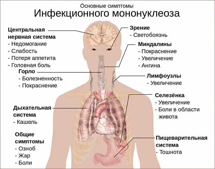 Симптомы инфекционного мононуклеоза