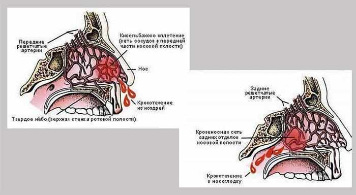 Виды носового кровотечения