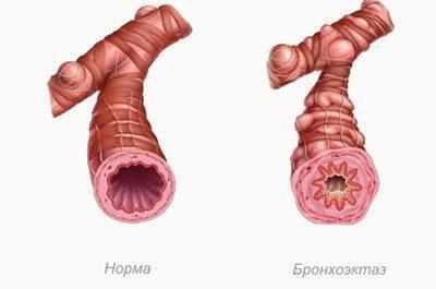 Проявление бронхоэктаза