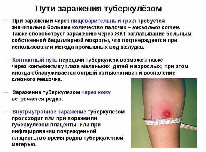 Пути заражения туберкулёзом
