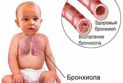 Бронхиолит у ребенка