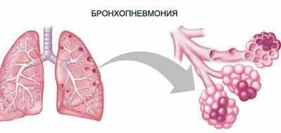 Следствие бронхопневмонии