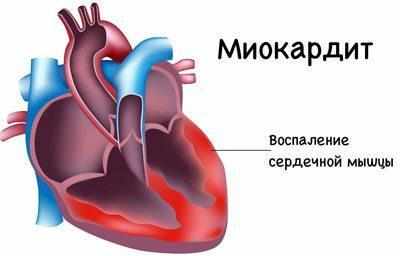 Миокардит сердца