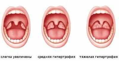 Увеличенные гланды
