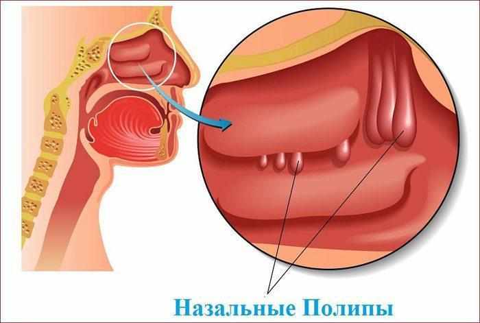 Полипы в носу