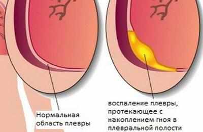 Гнойный плеврит