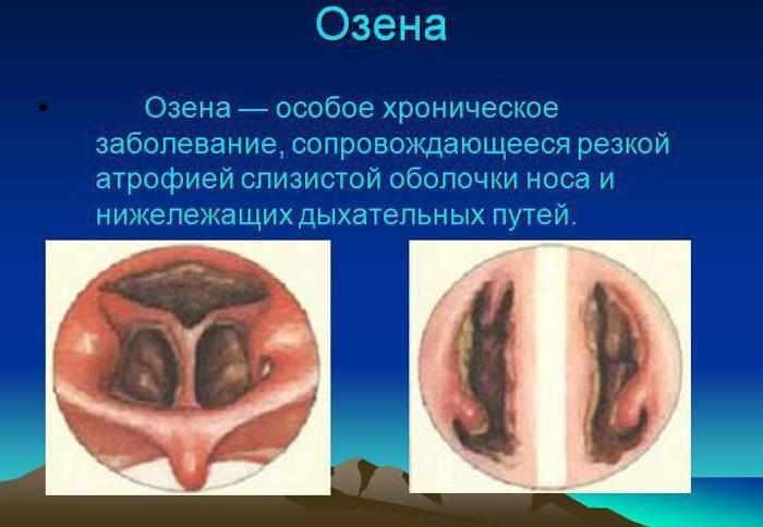 Понятие и причина озены