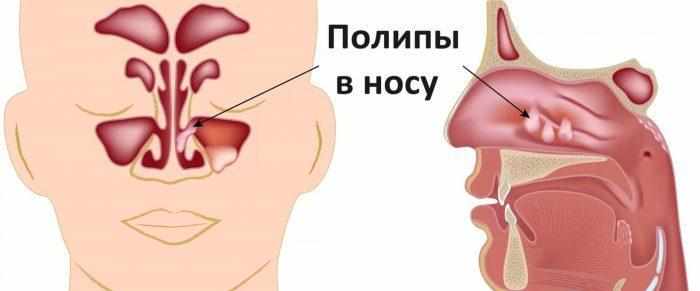 Полипы