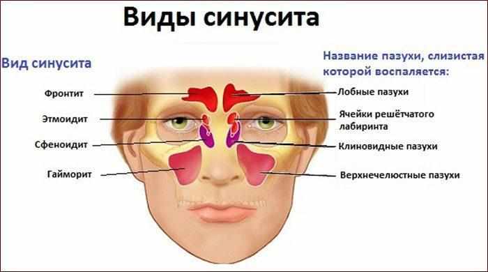 Виды синусита