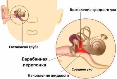 Средний отит