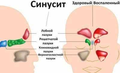 Виды синусита