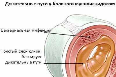 Проявление муковисцидоза
