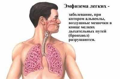 Эмфизема легких