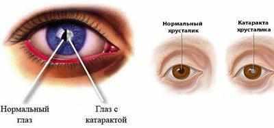 Катаракта глаза