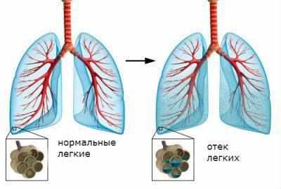 Отек легких