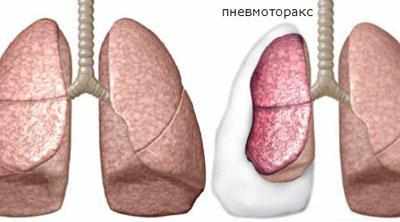 Пневмоторакс легкого