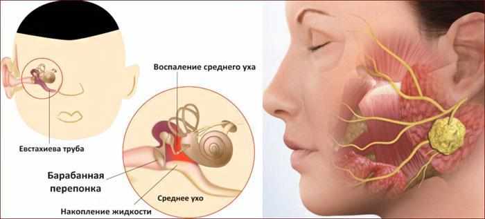 Воспаление среднего уха