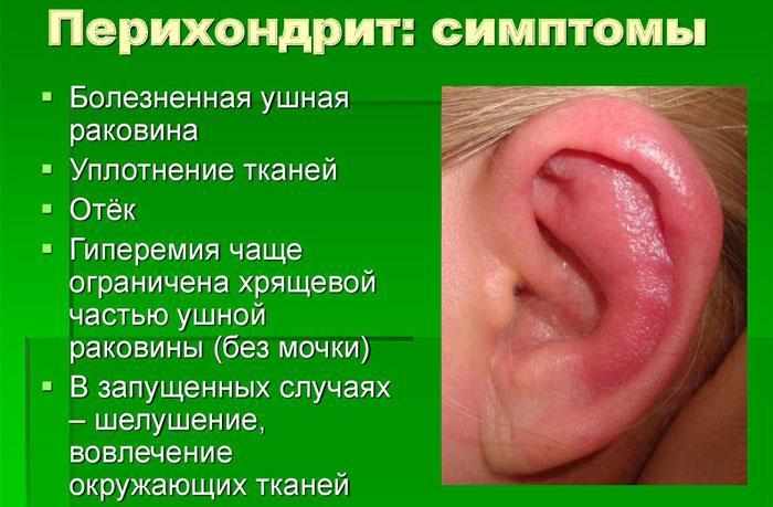 Симптомы перихондрита