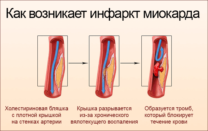 Как развивается инфаркт миокарда