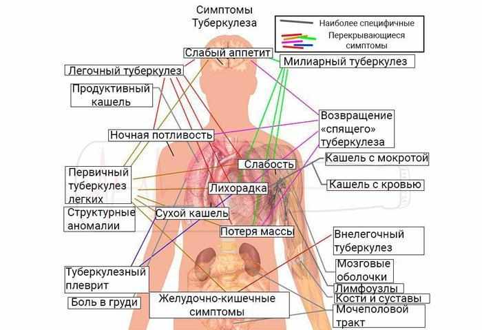 Симптомы туберкулеза