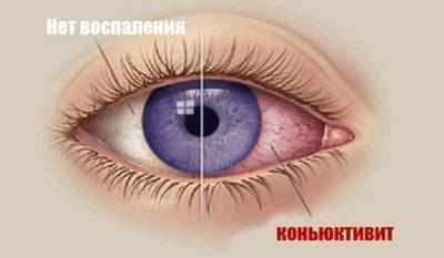 Глаз при конкъюктивите