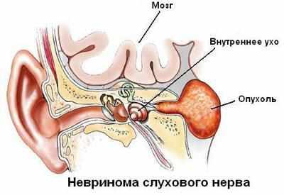 Локализация невриномы слухового нерва