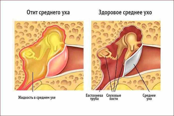 Отит среднего уха