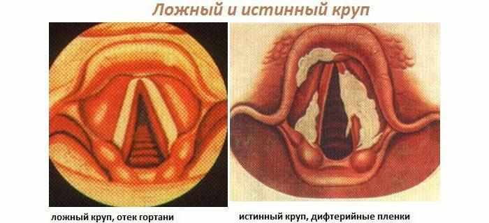 Дифтерийная форма или истинный круп