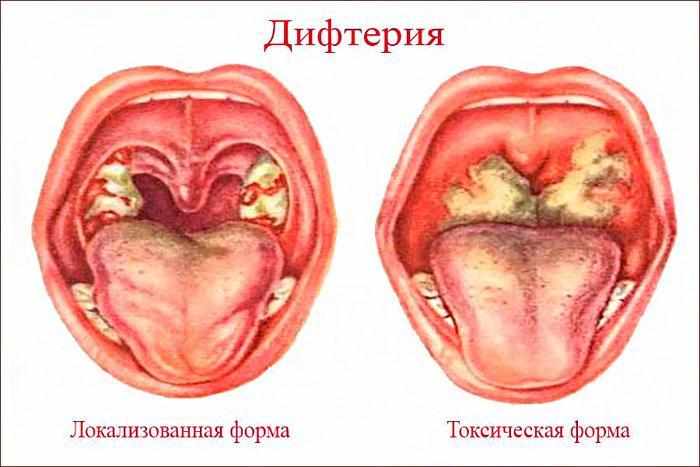 Симптомы дифтерии