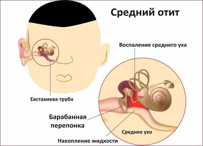 симптомы среднего отита