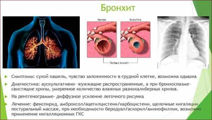 Симптомы бронхита