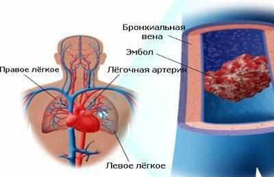 Легочная эмболия