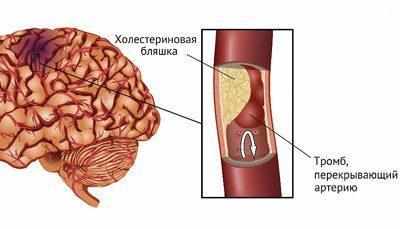 Ишемическая болезнь