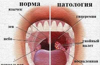 Миндалины при тонзиллите