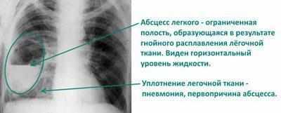 Абсцесс легкого на рентгене
