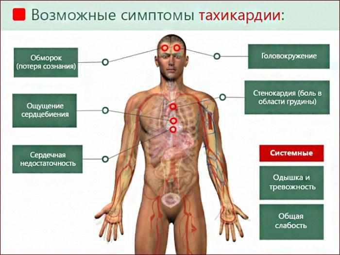 Симптомы тахикардии