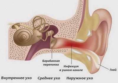 Гнойный отит