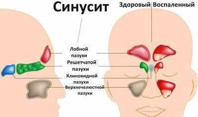 Виды синуситов