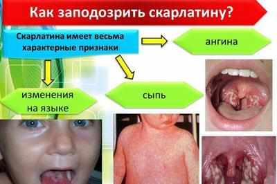 Признаки скарлатины