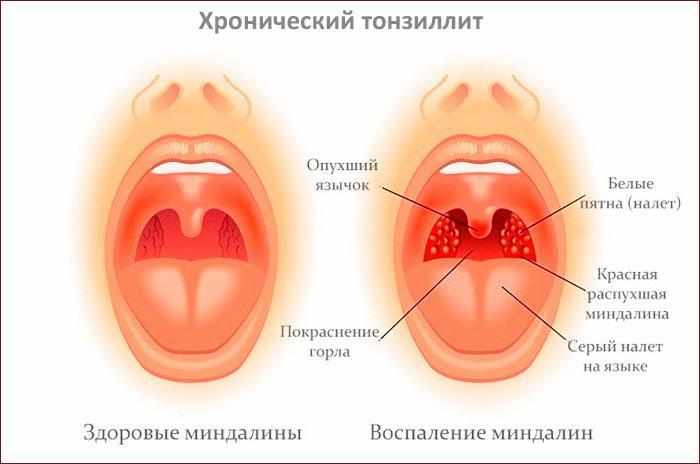 Симптомы хронического тонзиллита