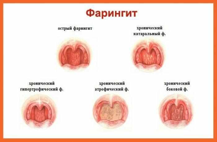 Типы фарингита