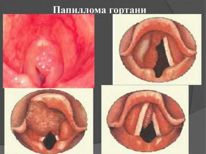 Папилломы на голосовых связках