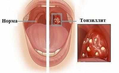 Горло при тонзиллите