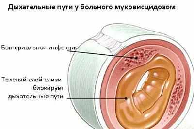 Следствие муковисцидоза