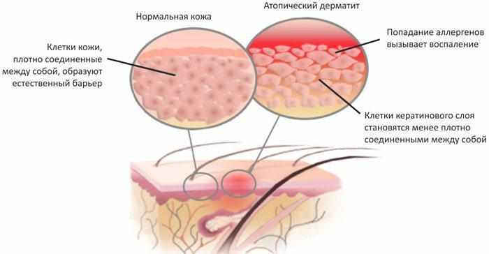 Атопический дерматит